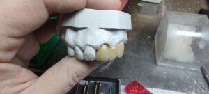 etapy napalania mostu ceramicznego 5