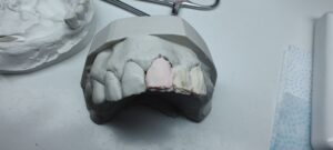 etapy napalania mostu ceramicznego1