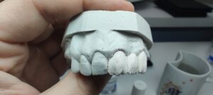 etapy napalania mostu ceramicznego2