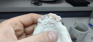 etapy napalania mostu ceramicznego3